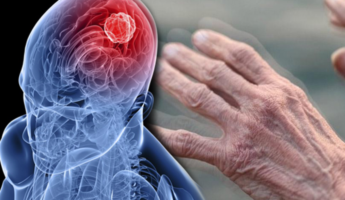 What are the symptoms of Parkinson’s disease? Can Parkinson’s disease be controlled with treatment?